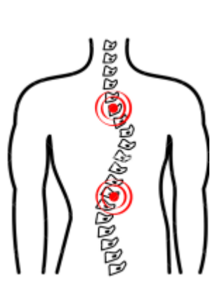 Scoliosis