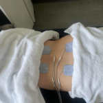 H WAVE- How Electrical Stimulation Can Help You